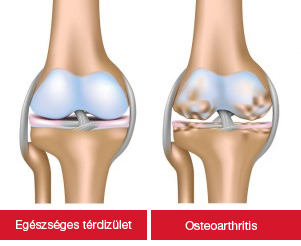 deformáló gerinctelen artrózis kezelés leggyorsabb módja a fogyásnak a lábakban